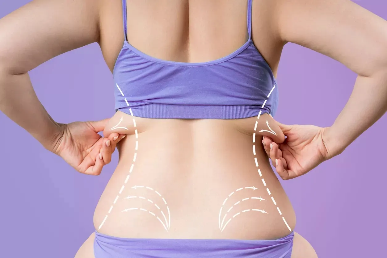 Hidrolipoclasia ultrasónica en Yeya Fisio-Spa