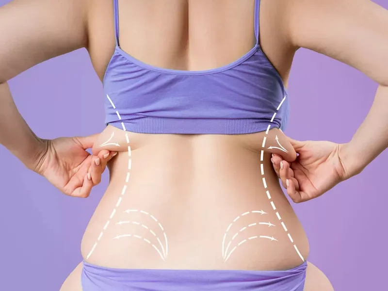 Hidrolipoclasia ultrasónica en Yeya Fisio-Spa