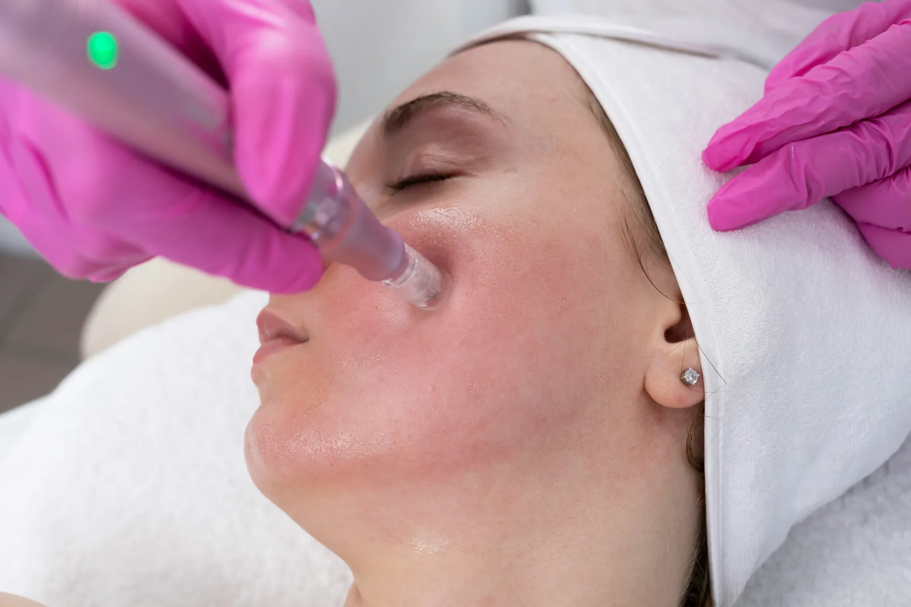 Limpieza facial y dermaplaning en Yeya Fisio-Spa