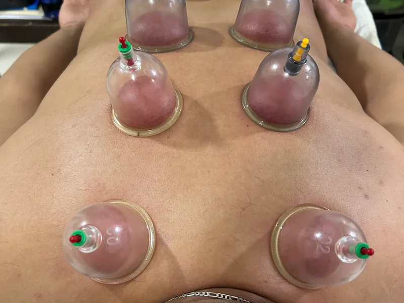 Ventosas terapéuticas en Yeya Fisio-Spa