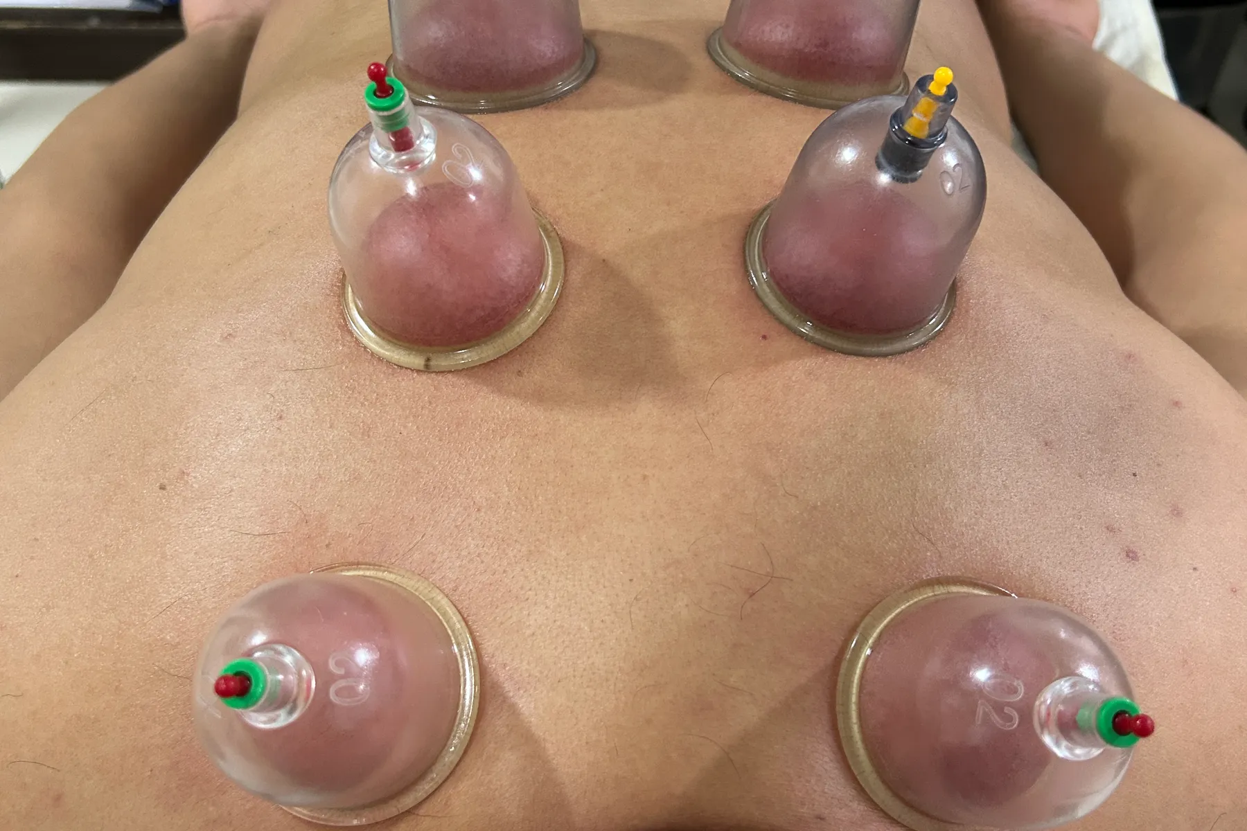 Ventosas terapéuticas en Yeya Fisio-Spa